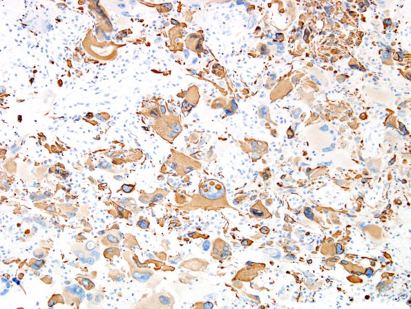 1B1 GBM, Giant Cell Type (Case 1) GFAP 3