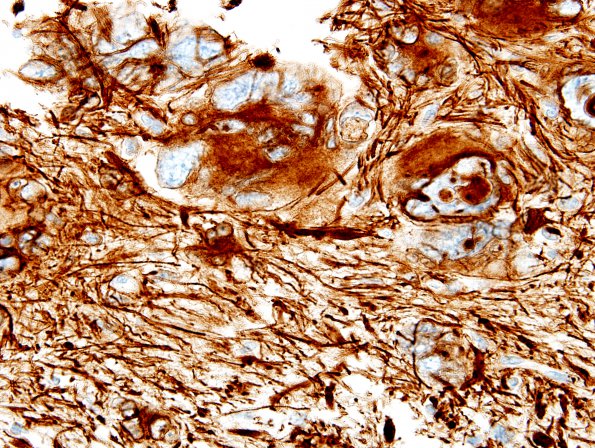 2B3 GBM w Giant Cell Features (Case 2) GFAP 1.jpg