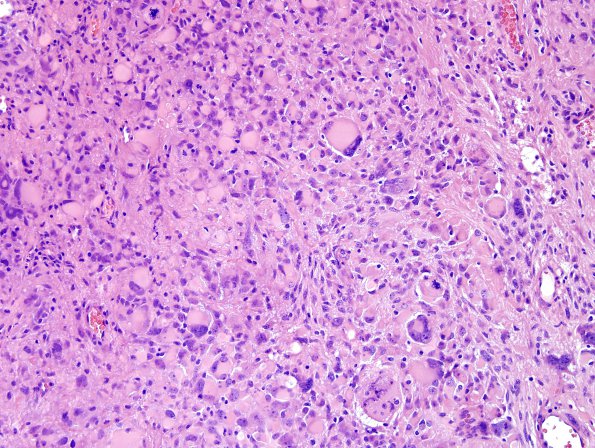 4A1 GBM, giant cell type (Case 4) H&E 4.jpg