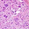 4A2 GBM, giant cell type (Case 4) H&E 1.jpg