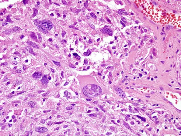 4A2 GBM, giant cell type (Case 4) H&E 1.jpg