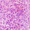 4A3 GBM, giant cell type (Case 4) H&E 7.jpg
