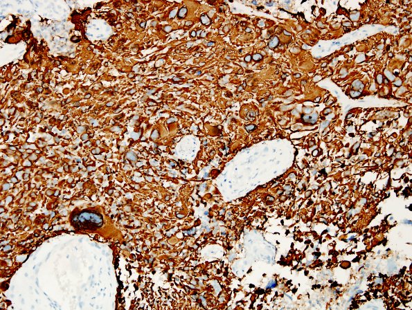 4B GBM, giant cell type (Case 4) GFAP 2.jpg