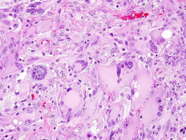 5A6 GBM, giant cell (Case 5) H&E 5