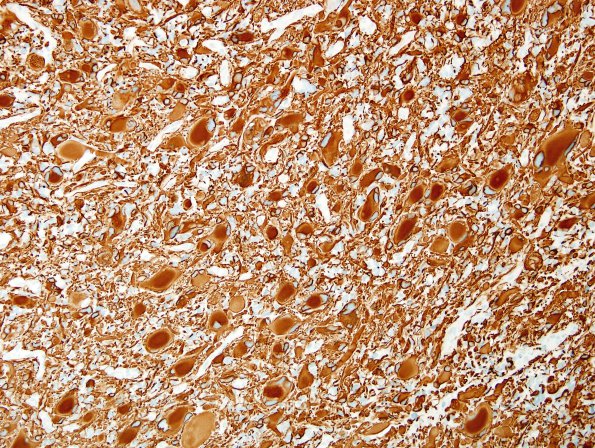 6B1 GBM, giant cell and PNET (Case 6) GFAP 1.jpg