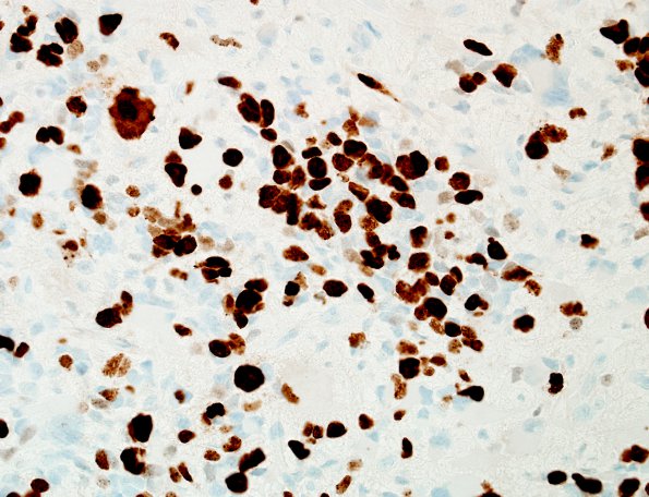 6C GBM, giant cell and PNET (Case 6) Ki67 1.jpg