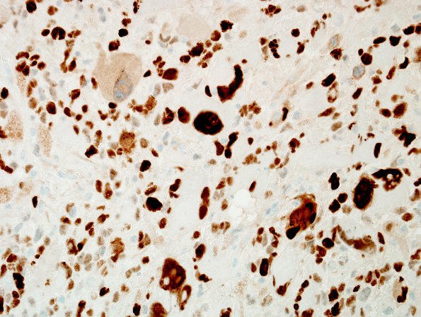 6D GBM, giant cell and PNET (Case 6) p53 1.jpg