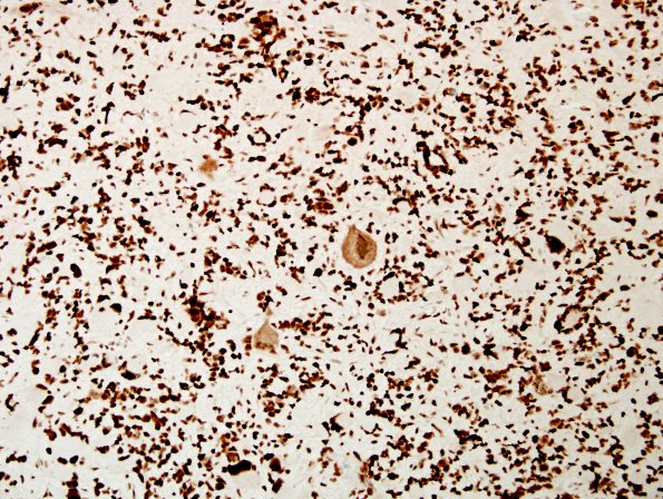 6E GBM, giant cell and PNET (Case 6) ATRX 2.jpg