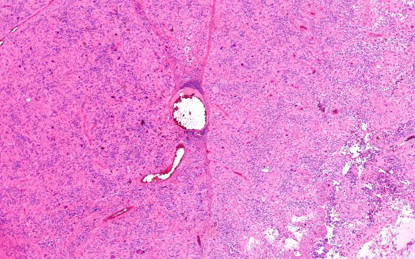 6F1 GBM, giant cell and PNET (Case 6) H&E endo prolif 4X