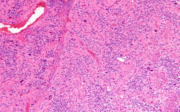 6F2 GBM, giant cell and PNET (Case 6) H&E endo prolif 10X