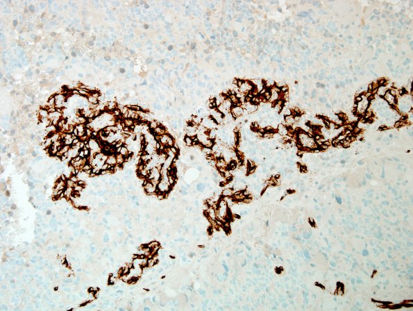 6G4 GBM, giant cell and PNET (Case 6) CD34 endo prolif 20X.jpg