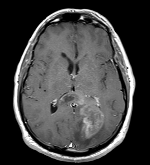 1A1 MRI GBM Granular cell variant (Case 1) 2 - Copy