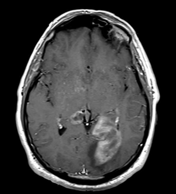 1A2 REPEAT MRI GBM, Granular cell variant (Case 1) 1 - Copy