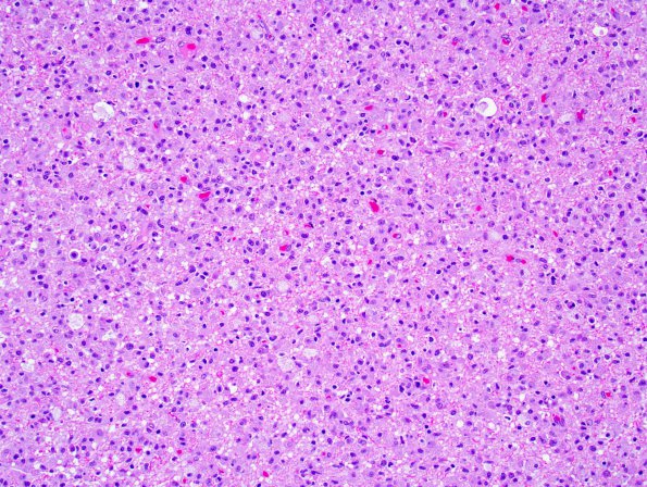 1B1 GBM, Granular cell variant (Case 1) 3.jpg