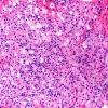 1B2 GBM, Granular cell variant (Case 1) H&E 40X 2