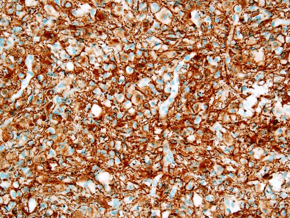 1C1 GBM, Granular cell variant (Case 1) GFAP 1.jpg