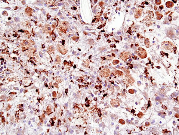 1D1 GBM, Granular cell variant (Case 1) CD68 1.jpg