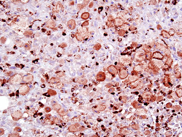 1D2 GBM, Granular cell variant (Case 1) CD68 2.jpg