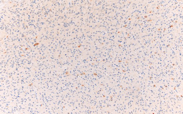 1E1 GBM, Granular cell variant (Case 1) CD163 20X