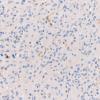 1E2 GBM, Granular cell variant (Case 1) CD163 40X