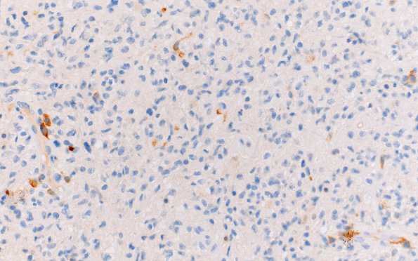 1E2 GBM, Granular cell variant (Case 1) CD163 40X