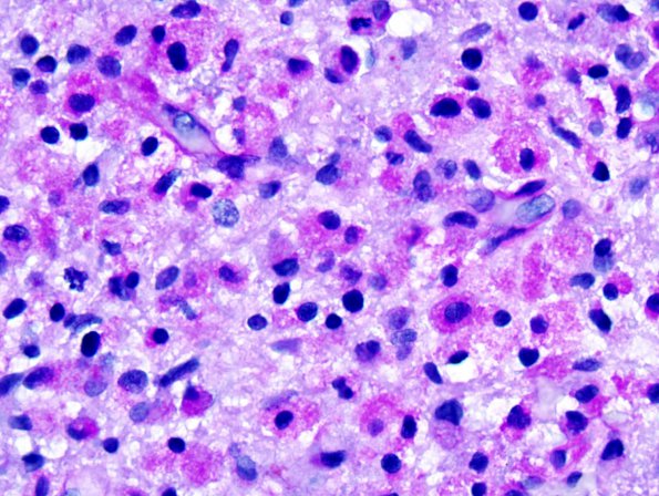 1F GBM, Granular cell variant (Case 1) PASD 2.jpg