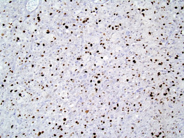 1G GBM, Granular cell variant (Case 1) Ki-67 1.jpg