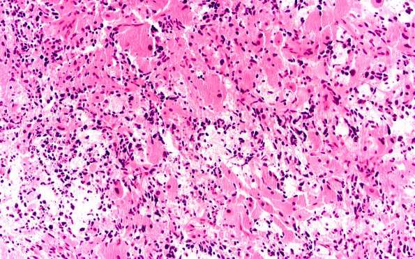 2A1 Glioblastoma, granular cell type (Case 2) 20X 1