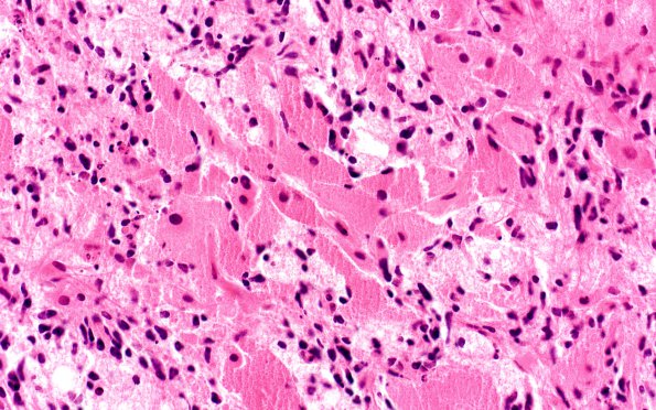 2A2 Glioblastoma, granular cell type (Case 2) 40X