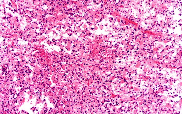 2A3 Glioblastoma, granular cell type (Case 2) H&E 20X 2