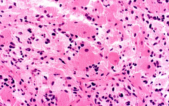 2A5 Glioblastoma, granular cell type (Case 2) H&E 40X