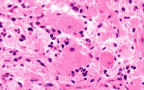 2A6 Glioblastoma, granular cell type (Case 2) H&E 60X