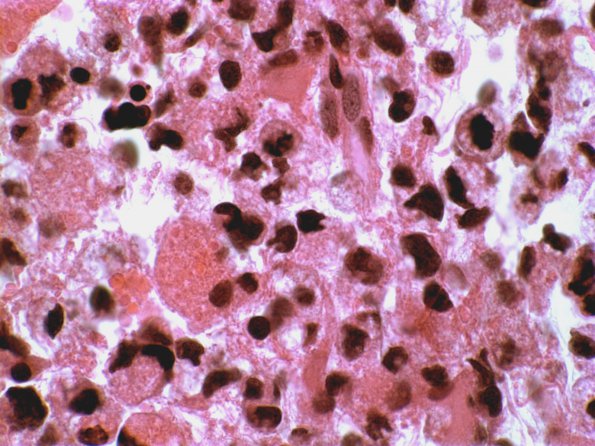 2A7 Glioblastoma, granular cell type (Case 2) H&E 1