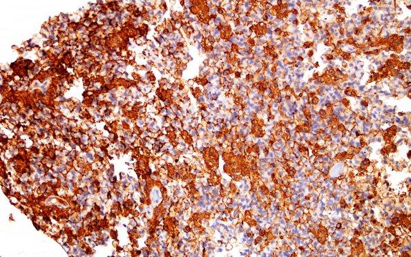 2B1 Glioblastoma, granular cell type (Case 2) GFAP 20X 1