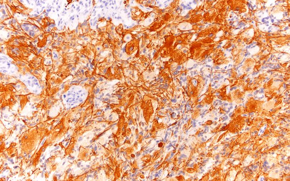 2B2 Glioblastoma, granular cell type (Case 2) GFAP 20X 3