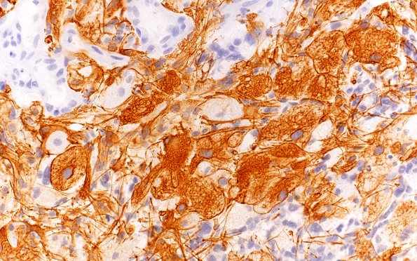 2B3 Glioblastoma, granular cell type (Case 2) GFAP 40X 3