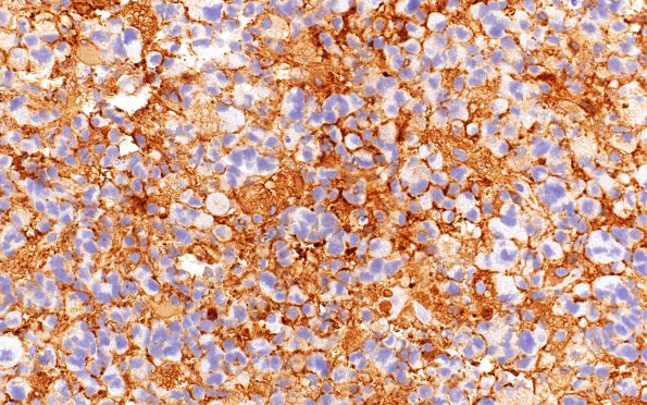 2B4 Glioblastoma, granular cell type (Case 2) GFAP 40X 2