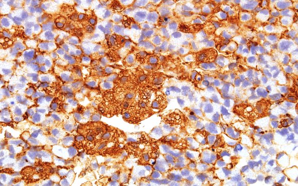 2B5 Glioblastoma, granular cell type (Case 2) GFAP 60X 1