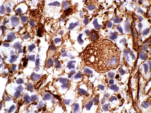 2B6 Glioblastoma, granular cell type (Case 2) GFAP c