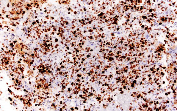 2C Glioblastoma, granular cell type (Case 2) Ki67 20X