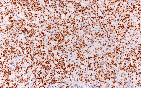 2D Glioblastoma, granular cell type (Case 2) P53 20X 2