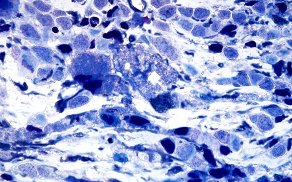 2E3 Glioblastoma, granular cell type (Case 2) Plastic 100X 2