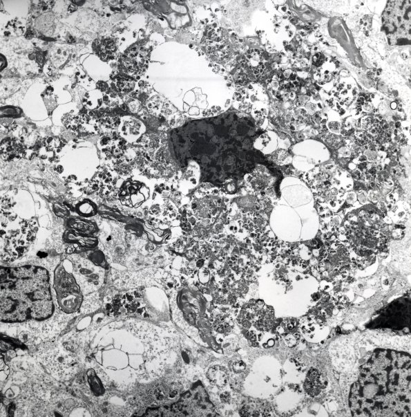 2F2 GBM, granular (Case 2) EM 3 - Copy