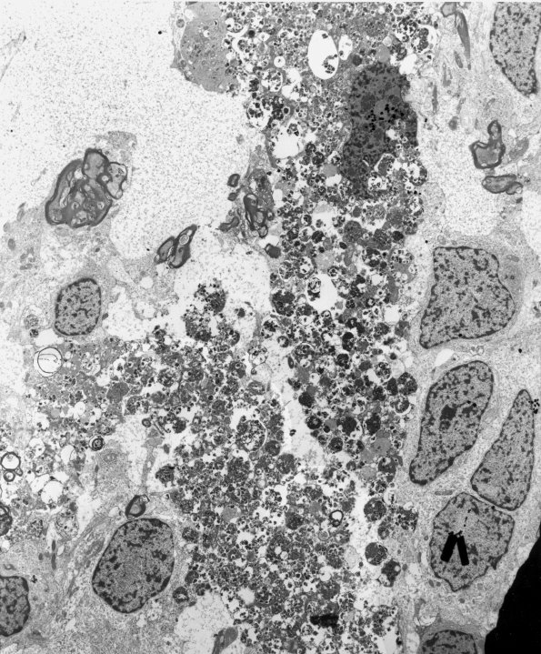 2F3 GBM, granular (Case 2) EM2 - Copy