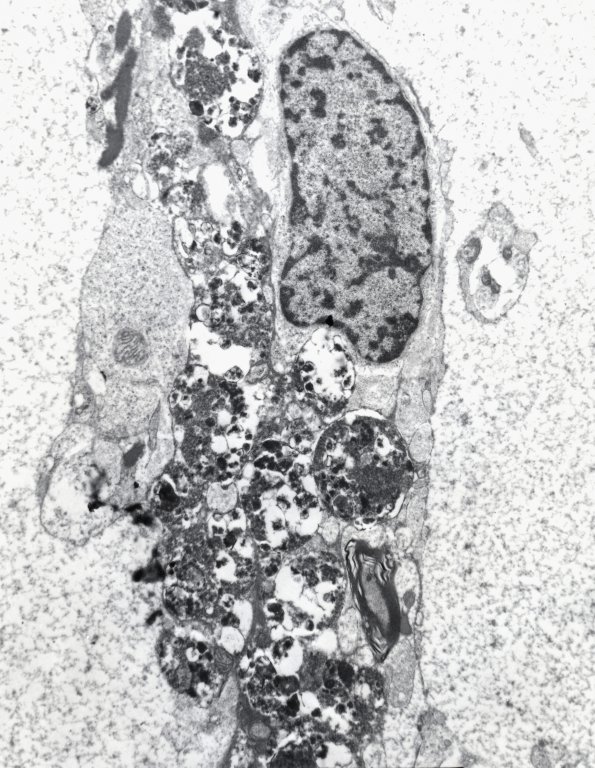 2F4 GBM, granular (Case 2) EM 2 - Copy