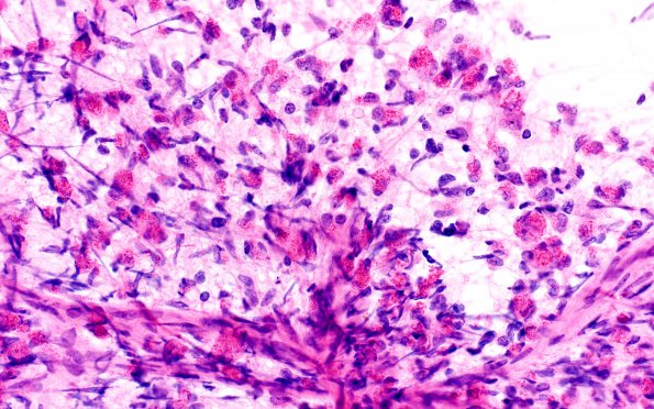 3A1 Glioblastoma, granular cell type (Case 3) Sm 40X 1