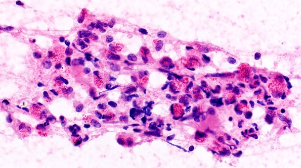 3A2 Glioblastoma, granular cell type (Case 3) Sm 40X 2