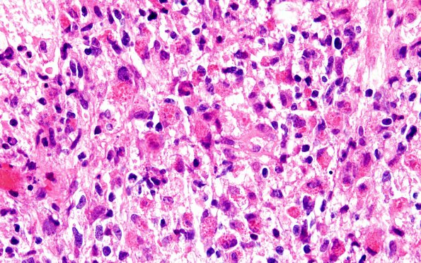 3A3 Glioblastoma, granular cell type (Case 3) FS 60X 2