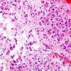 3A5 Glioblastoma, granular cell type (Case 3) H&E 5.jpg