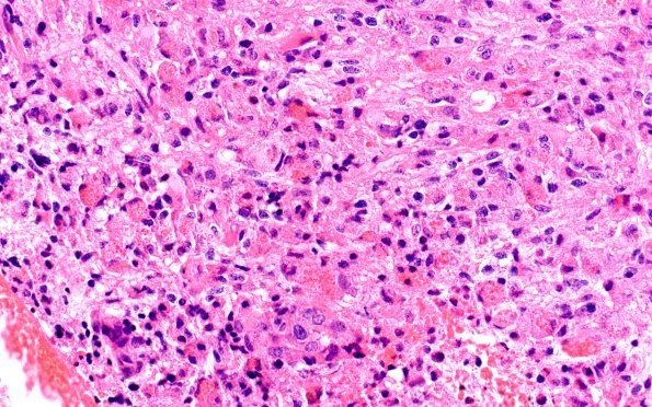 3A6 Glioblastoma, granular cell type (Case 3) FS 40X 2